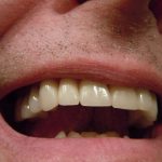 5 Suggestions To Select The Proper Shade For a Dental Crown