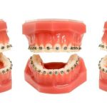 Varieties of Dental Braces and Its Advantages