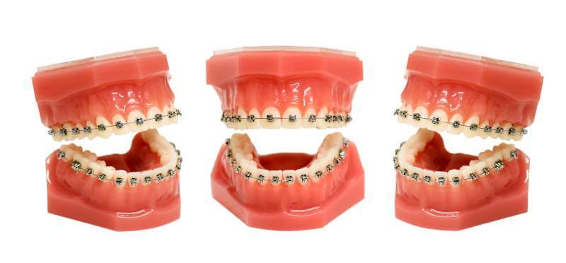 Varieties of Dental Braces and Its Advantages